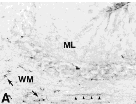 Expression of differential immune factors in temporal cortex and cerebellum: The role of -1-antichymotrypsin, apolipoprotein E, and reactive glia in the progression of Alzheimer s disease
