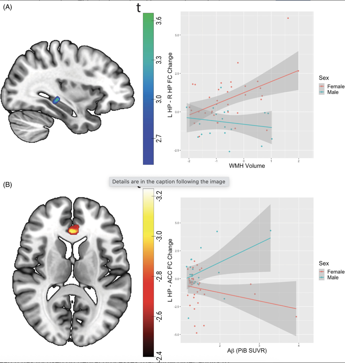 Sex dependent alterations in hippocampal connectivity are linked to cerebrovascular and amyloid pathologies in normal aging
