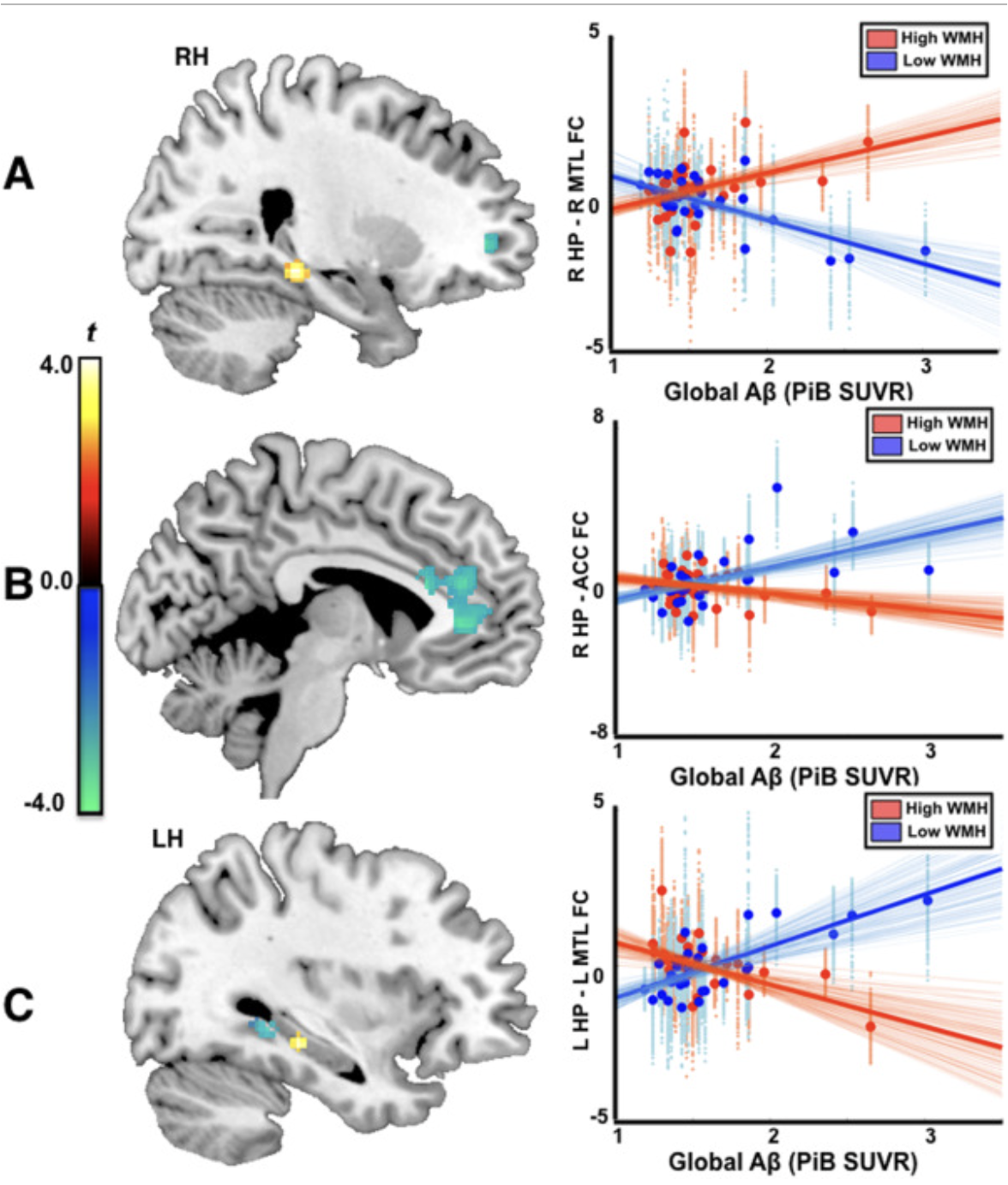 In Pre-Clinical AD Small Vessel Disease is Associated With Altered Hippocampal Connectivity and Atrophy