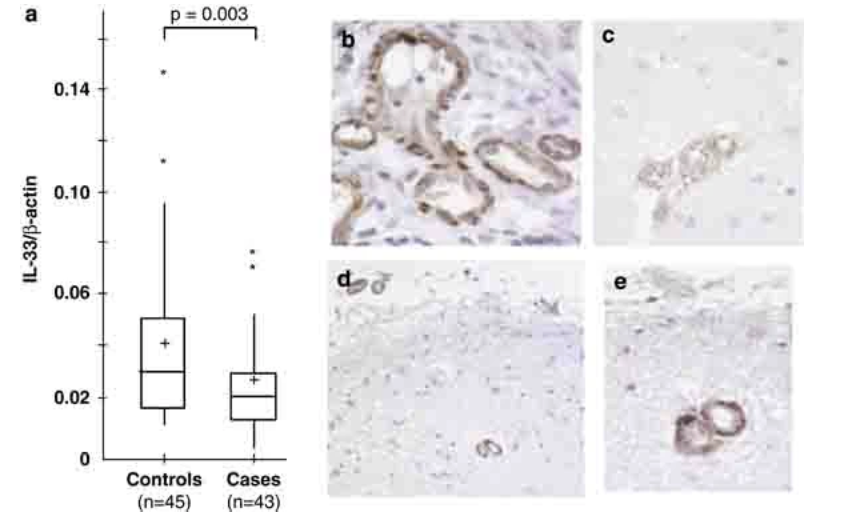 Transcriptomic and genetic studies identify IL-33 as a candidate gene for Alzheimer s disease