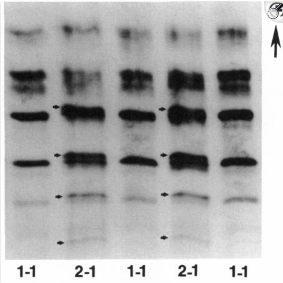 Genetic studies of human apolipoproteins. IX. Apolipoprotein D polymorphism and its relation to serum lipoprotein lipid levels.